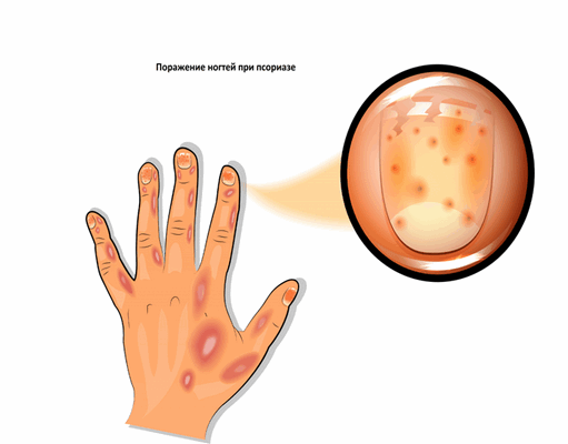 поражение ногтей при псориазе.png