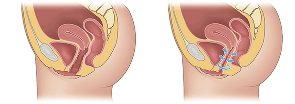 осложнения