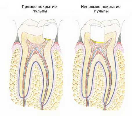 Прямое и непрямое покрытие пульпы