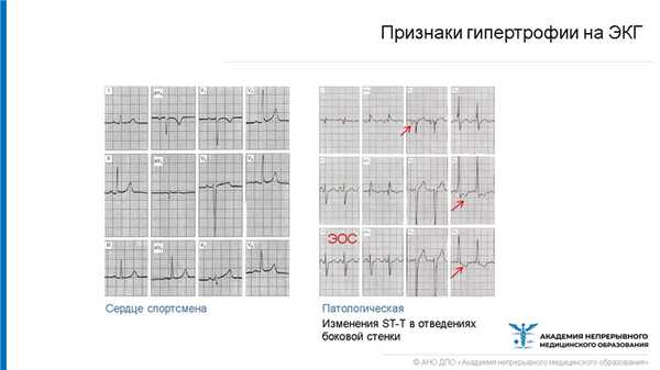 Признаки гипертрофии на ЭКГ