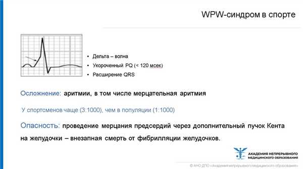 WPW-синдрома в спорте