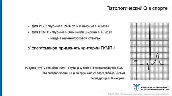 Патологический Q в спорте