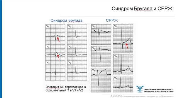Синдром Бругада и СРРЖ