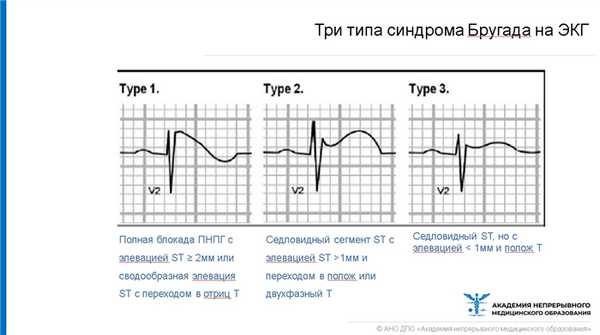 Типы синдрома Бругада