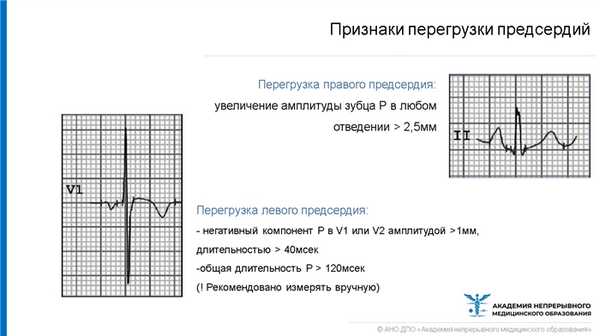 Признаки перегрузки предсердий