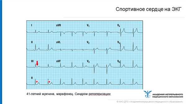 Спортивное сердце на ЭКГ