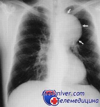 аневризма аорты