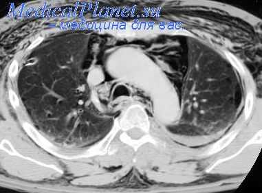 рентгенокимография