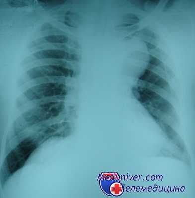 тени средостения