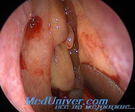 пункция при синуите