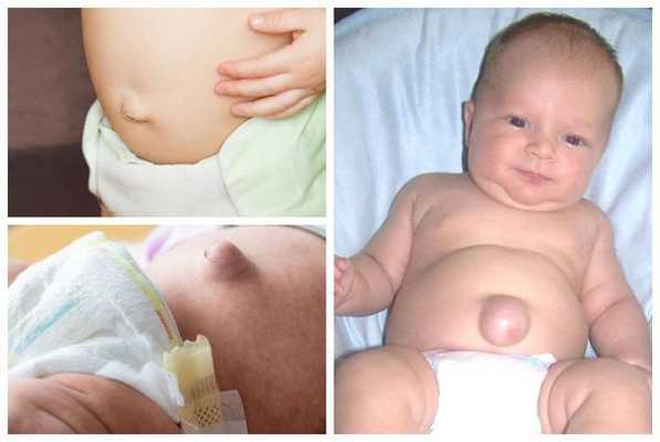 Малая, большая и гигантская грыжи