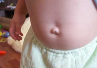 Пупочная грыжа у ребенка