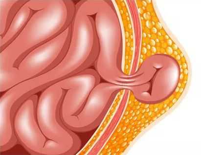 Ущемлённая грыжа