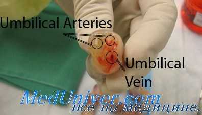 доношенная пуповина плода - перед катетеризацией