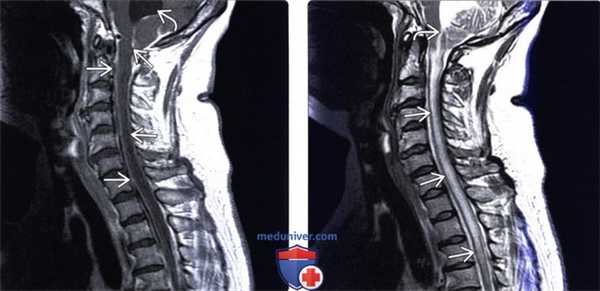 МРТ спинального менингита