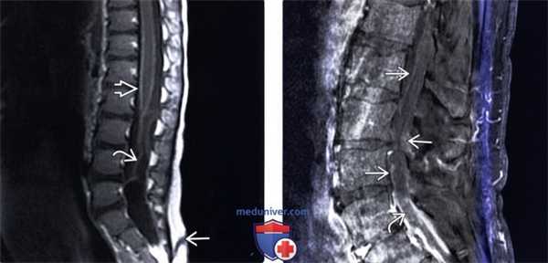 МРТ спинального менингита