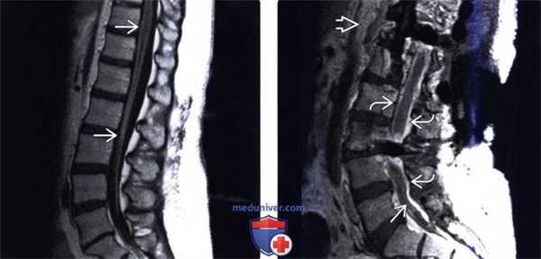 МРТ спинального менингита