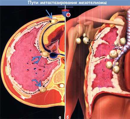 Пути метастазирования мезотелиомы в лимфатические узлы