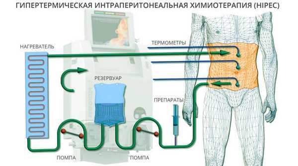 Гипертермическая интраперитонеальная химиотерапия (HIPEC)