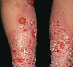 пузырчатка вульгарная