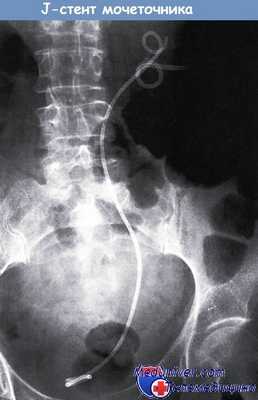 J-стент мочеточника