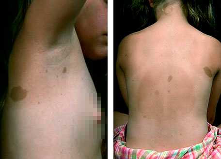 Кофейные пятна в подмышечной области