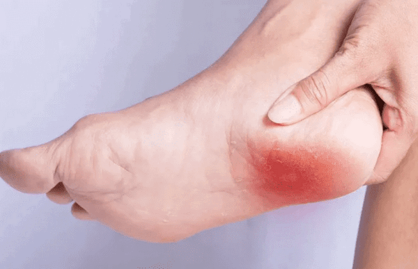 Лечение пяточной шпоры