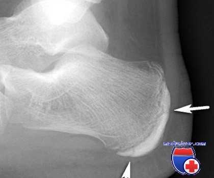 пяточный эпифизит