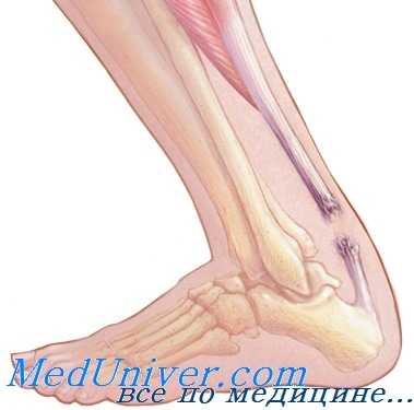 разрыв ахиллова сухожилия