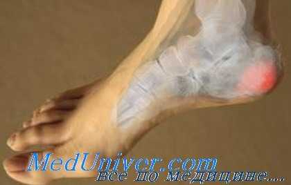 боль в пятке