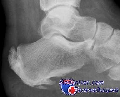 боль в пятке