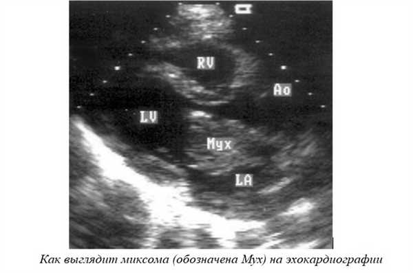 Как выглядит миксома (обозначена Myx) на эхокардиографии