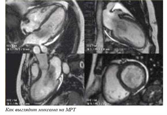 Как выглядит миксома на МРТ