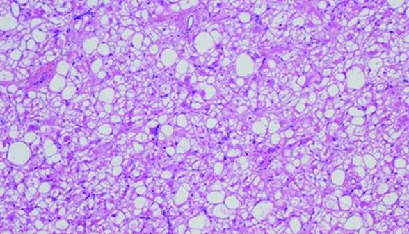 Сердечная рабдомиома гистология