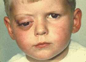 Рабдомиосаркома