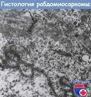 Гистология рабдомиосаркомы