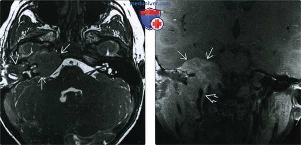 КТ, МРТ при рабдомиосаркоме височной кости