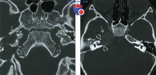 КТ, МРТ при рабдомиосаркоме височной кости