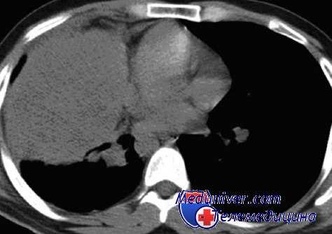 линберг в торакальной хирургии