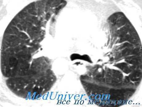 травма трахеи и бронхов