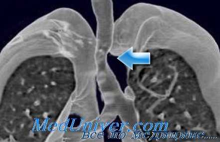 травма трахеи и бронхов