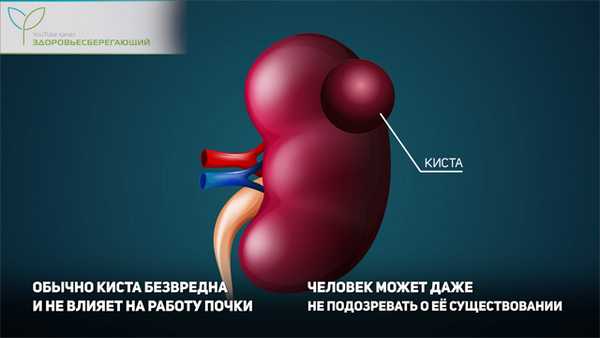 Киста почки