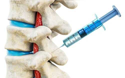 Инъекции при радикулите