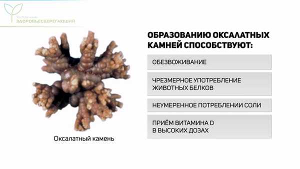 Оксалатный камень