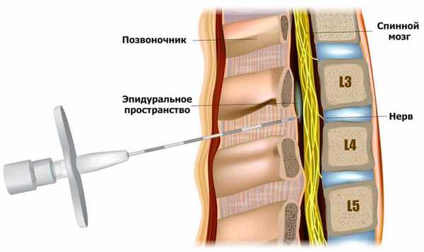Эпидуральная инъекция при радикулите