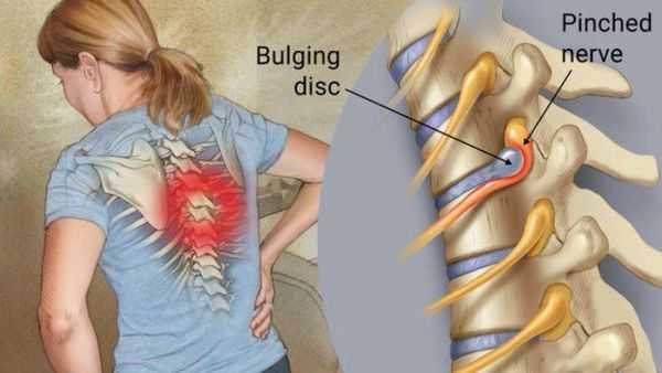 Локализация боли в спине