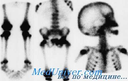 радиоизотопное исследование костей