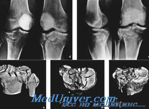 компьютерная томография костей
