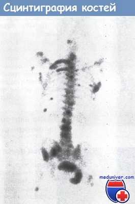 Сцинтиграфия костей