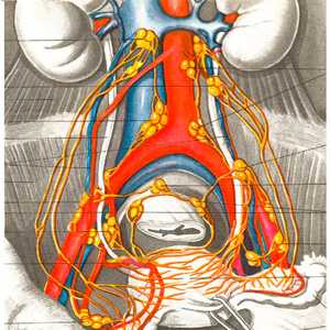 Рак тела матки